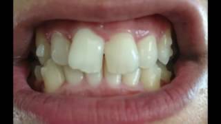 Invisalign Full Timelapse [upl. by Enirok]