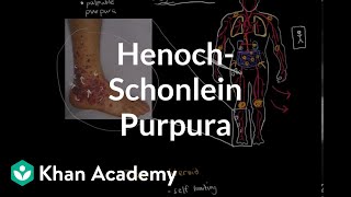 HenochSchonlein purpura  Circulatory System and Disease  NCLEXRN  Khan Academy [upl. by Atelokin]