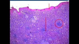 Sarcoidosis Rhino Actinomycosis Leprosy FB 2024  jars and slides [upl. by Jeannine]