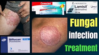 Tinea cruris  how to treat fungal infection  tinea capitis  fungal infection in private parts [upl. by Mclaughlin]