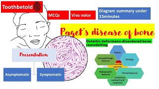 Pagets disease of bone  RadiographHISTOPATHOLOGYclinical features  NBDENEET MDSBDS  Diagrams [upl. by Haukom]