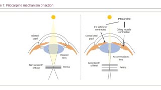 Using Muscarinic Agonist drugs Pilocarpine to treat Glaucoma [upl. by Vahe]