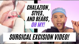 Incision and Drainage of Chalazion [upl. by Lotsyrk]