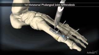 1st Metatarsal Phalangeal Joint Arthrodesis [upl. by Docila]