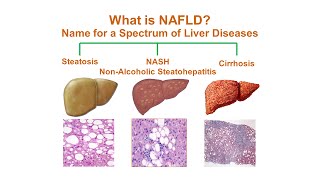 What is NonAlcoholic Fatty Liver Disease NAFLD [upl. by Fidellia149]