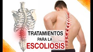 ¿Cuáles son los tratamientos para Escoliosis lumbar dorsal [upl. by Innoc]