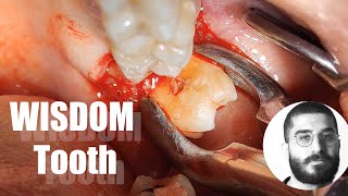 Should you extract the upper wisdom tooth after extracting the lower [upl. by Aurea]