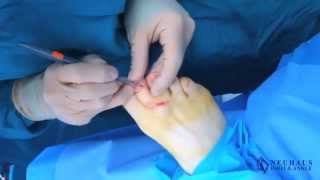 Cyst Removal Surgery Performed by Dr Matthew Neuhaus [upl. by Aicilihp377]