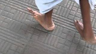 Talipes Calcaneus Deformity Walking Video [upl. by Elacim]