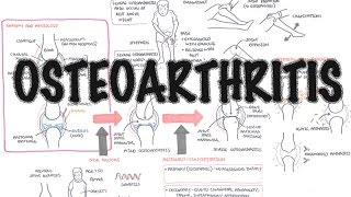 Osteoarthritis Overview causes pathophysiology investigations treatment [upl. by Weksler]