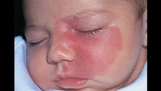 Hemangioma  MSK Module [upl. by Marysa382]