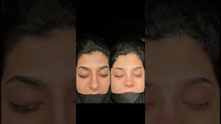 Closed Rhinoplasty in Turkey Result Before and After [upl. by Wolfgram]