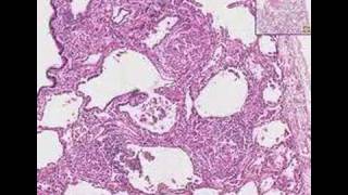 Histopathology LungSarcoidosis [upl. by Mode]