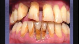 Causas da doença periodontal [upl. by Nihcas]