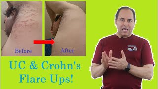 UC amp Crohns Flare Ups  Prevention amp Treatment [upl. by Rickey]