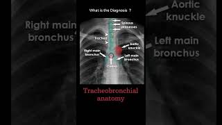 Tracheobronchial anatomy 171 Chest xray tube Quiz radiologychannel007 [upl. by Anillek]