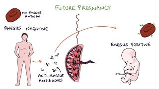 Understanding Rhesus Status and AntiD in Pregnancy [upl. by Ahsuatan]