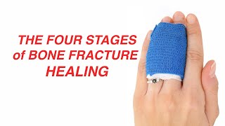 The Four Stages of Bone Fracture Healing [upl. by Trevah]