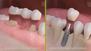 Straumann  Behandeling met een driedelige brug amp Implantaatbehandeling bij een ontbrekende tand [upl. by Anotyad]