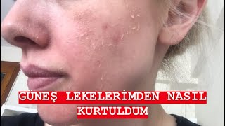 EYLÜL ÖZTÜRKGÜNEŞ LEKELERİMDEN NASIL KURTULDUMCİLTBAKIMI [upl. by Jaban652]