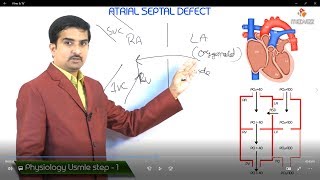 Atrial Septal Defect ASD USMLE Step 1 Pathophysiology [upl. by Munshi]