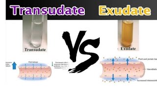 Transudate and Exudate pathology transudate Vs ExudateEasy to understand pathology [upl. by Lekim555]