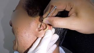 Removing Huge Hard Earwax From Elderly Mans Ear [upl. by Omero]