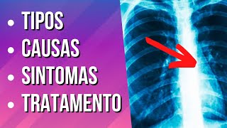 DERRAME PLEURAL  Causas Sintomas e Tratamento [upl. by Nolrac621]