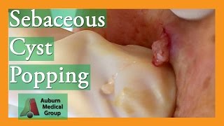 Epidermoid Cyst Popping popping  Auburn Medical Group [upl. by Yvonne]