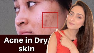 Acne in Dry Skin  what to use  serums creams  Dermatologist recommends [upl. by Llennyl]