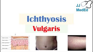 Ichthyosis Vulgaris  Causes Signs amp Symptoms Diagnosis Treatment [upl. by Ehgit12]