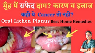 Lecture43 Lichen Planus and Lichenoid disorders Rooks chapter 37 [upl. by Adahs]