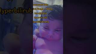 ازاي تعرف حالة IDM  Macrosomic baby ببساطة 👌👌 [upl. by Ayom]