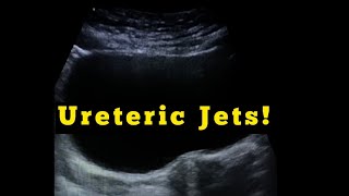 Ureteral Jets Ultrasound  is this a disease [upl. by Eiclud329]