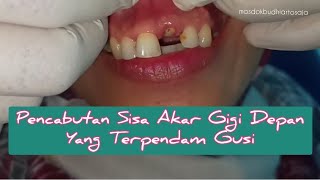 Sisa Akar Terpendam Gigi Depan Atas Sering Bikin Bengkak Gusi Dan Bibir Akhirnya Bisa Tercabut [upl. by Auqemahs275]