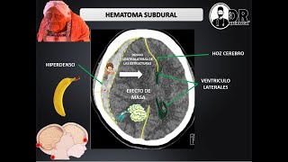 HEMATOMAS INTRACRANEALES EPIDURAL Y SUBDURAL  Como describir una Tomografía de cráneo [upl. by Eynenihc]