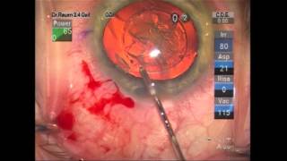 HD LenSx ProcedureFemtosecond laser assisted cataract surgery [upl. by Tahpos]