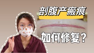 剖腹产术后疤痕如何淡化？愿每个准妈妈都能远离疤痕困扰cesarean section scar [upl. by Va350]