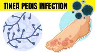 Tinea Pedis Infection Athletes Foot  Causes Types Signs amp Symptoms And Treatment [upl. by Stegman638]