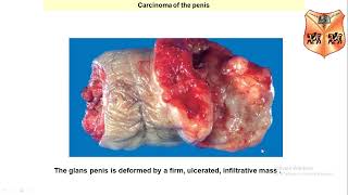 Male Genital System Pathology Penile and Testicular Areas [upl. by Zimmermann787]