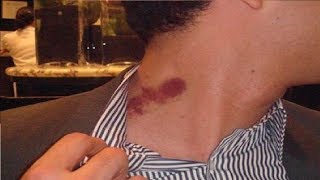 how to get rid of a hickey fast in seconds [upl. by Acinomed]