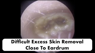 VERY DIFFICULT DEAD SKIN REMOVAL CLOSE TO THE EARDRUM  Ep 18 [upl. by Ademla]