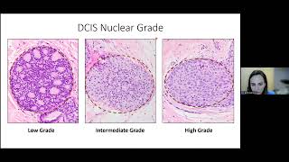 DCIS  A Pathologists Perspective  2023 Ductal Carcinoma In Situ Patient Forum [upl. by Nortyad480]