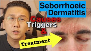 Seborrhoeic Dermatitis  Causes Triggers amp Treatment Options [upl. by Joacimah]