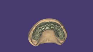 exocad bredent vs3 attachment  neolign veener teeth fit checkdigital index [upl. by Ikciv]