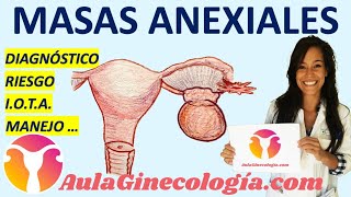 MASAS ANEXIALES DIAGNÓSTICO ECOGRAFÍA CÁLCULO DE RIESGO MANEJO  Ginecología y Obstetricia [upl. by Balas301]