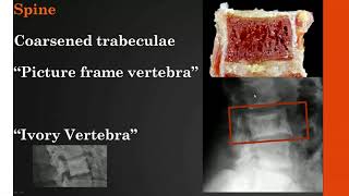 Imaging Paget disease of bone [upl. by Elka55]