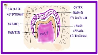 Dentigerous cyst [upl. by Noraha]