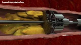 Stent Angioplasty Procedure [upl. by Sidell]