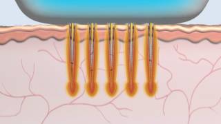 Animation Radiofréquence MicroNeedle Secret [upl. by Yelehsa]